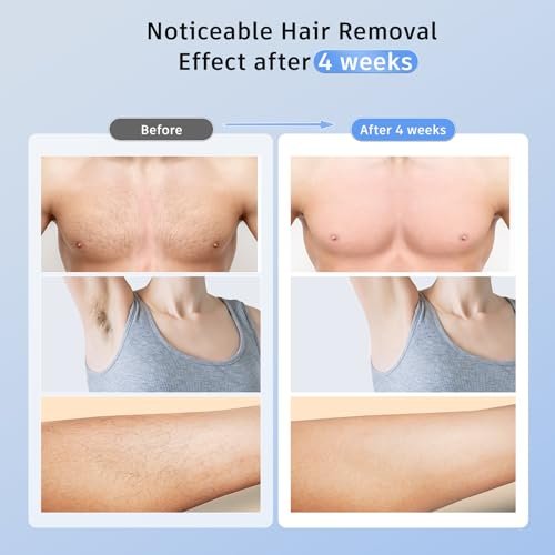 Laser Hair Removal with 5℃ Ice Cooling, Painless IPL Laser H...